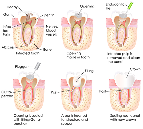 Franklin Lakes root canal